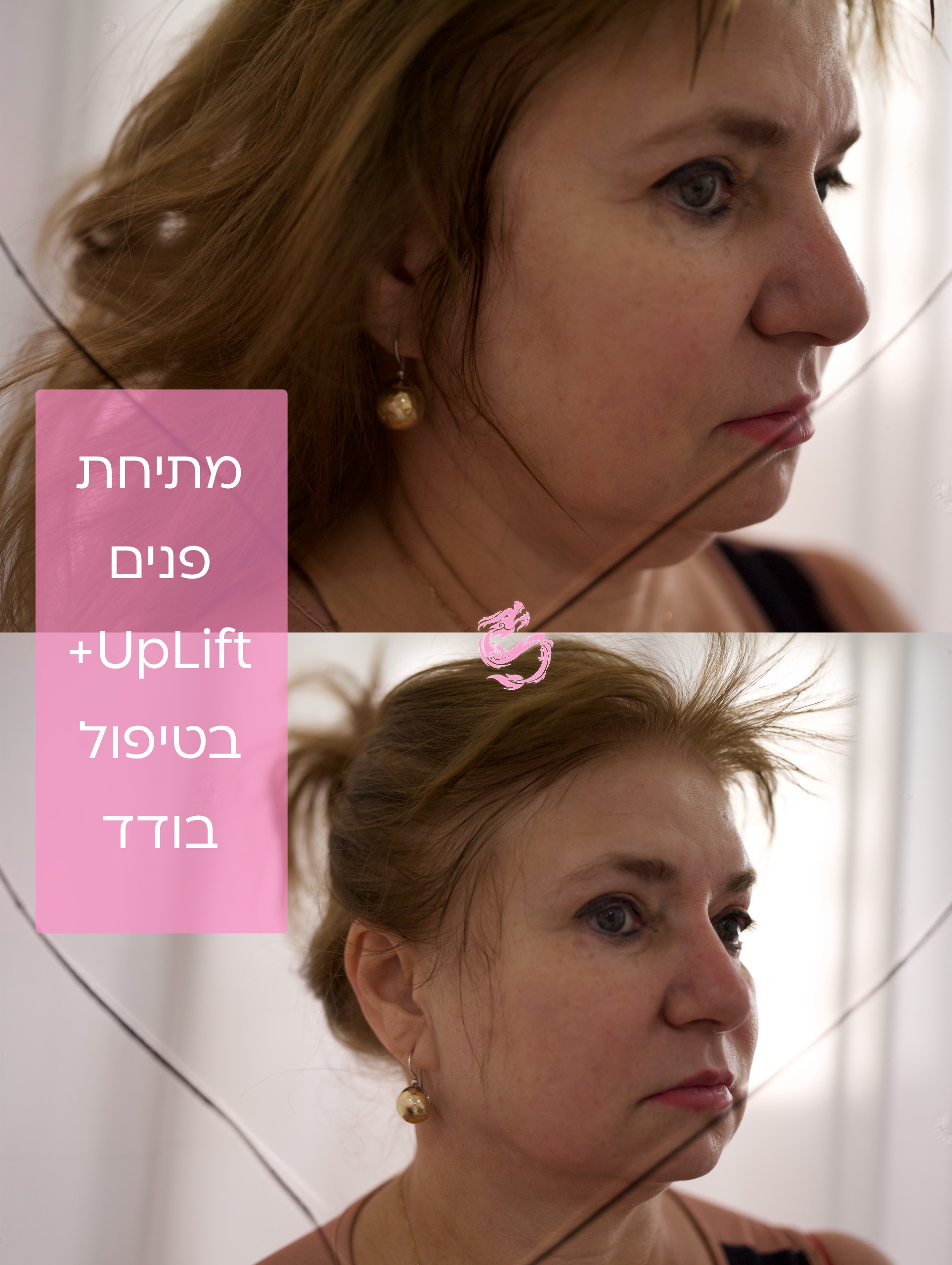UpLift - מתיחת פנים בלייזר שמבטלת צורך בניתוח 6 L1000203
