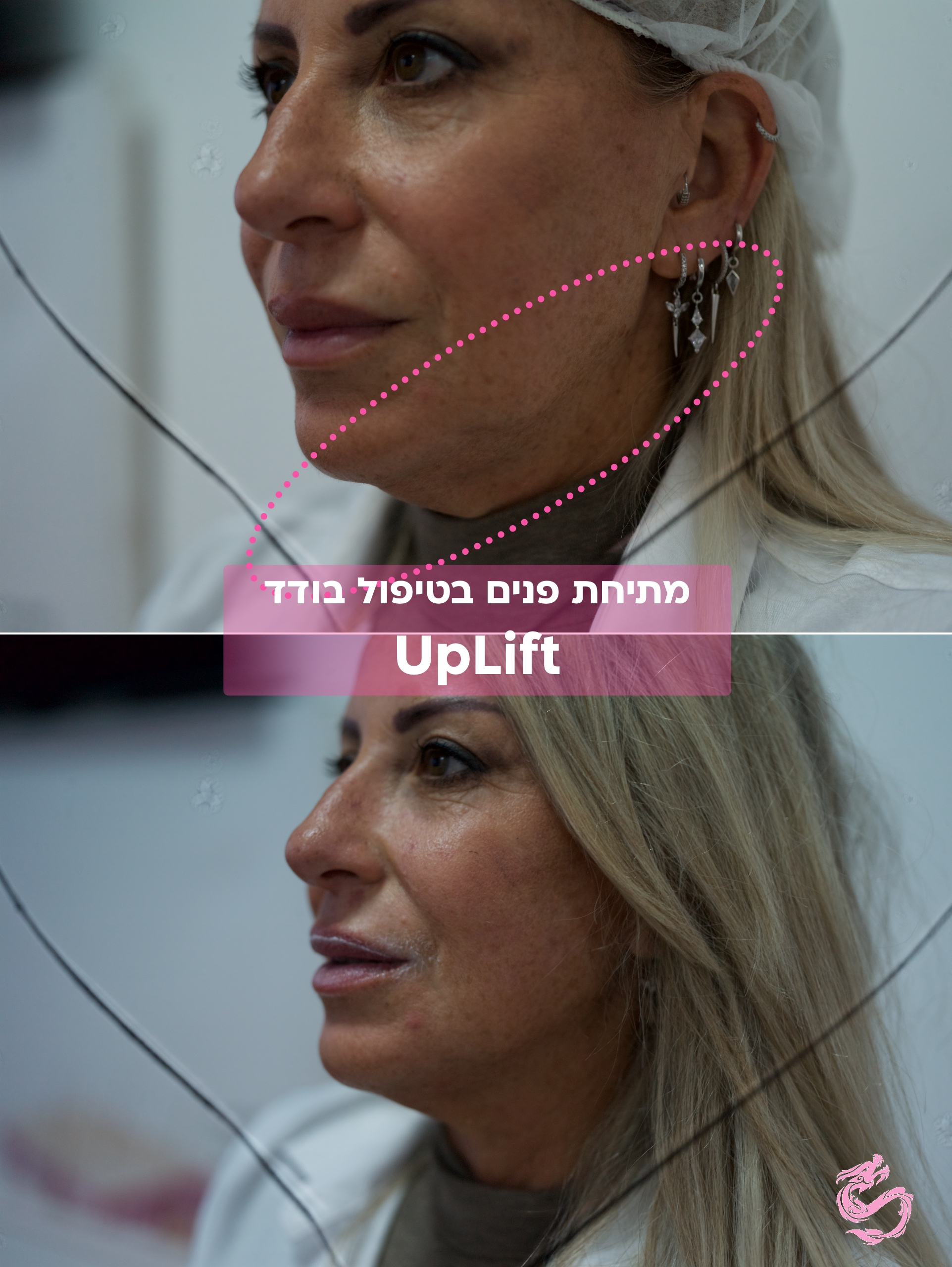 UpLift - מתיחת פנים בלייזר שמבטלת צורך בניתוח 5 תוצאה של מתיחת פנים בטיפול בודד