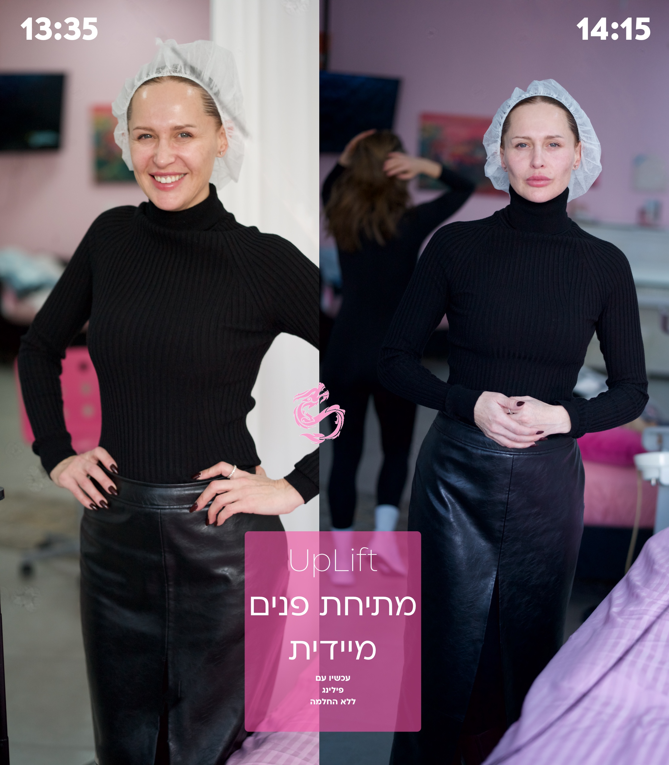 UpLift - מתיחת פנים בלייזר שמבטלת צורך בניתוח 2 מתיחת פנים כירורגית ללא החלמה