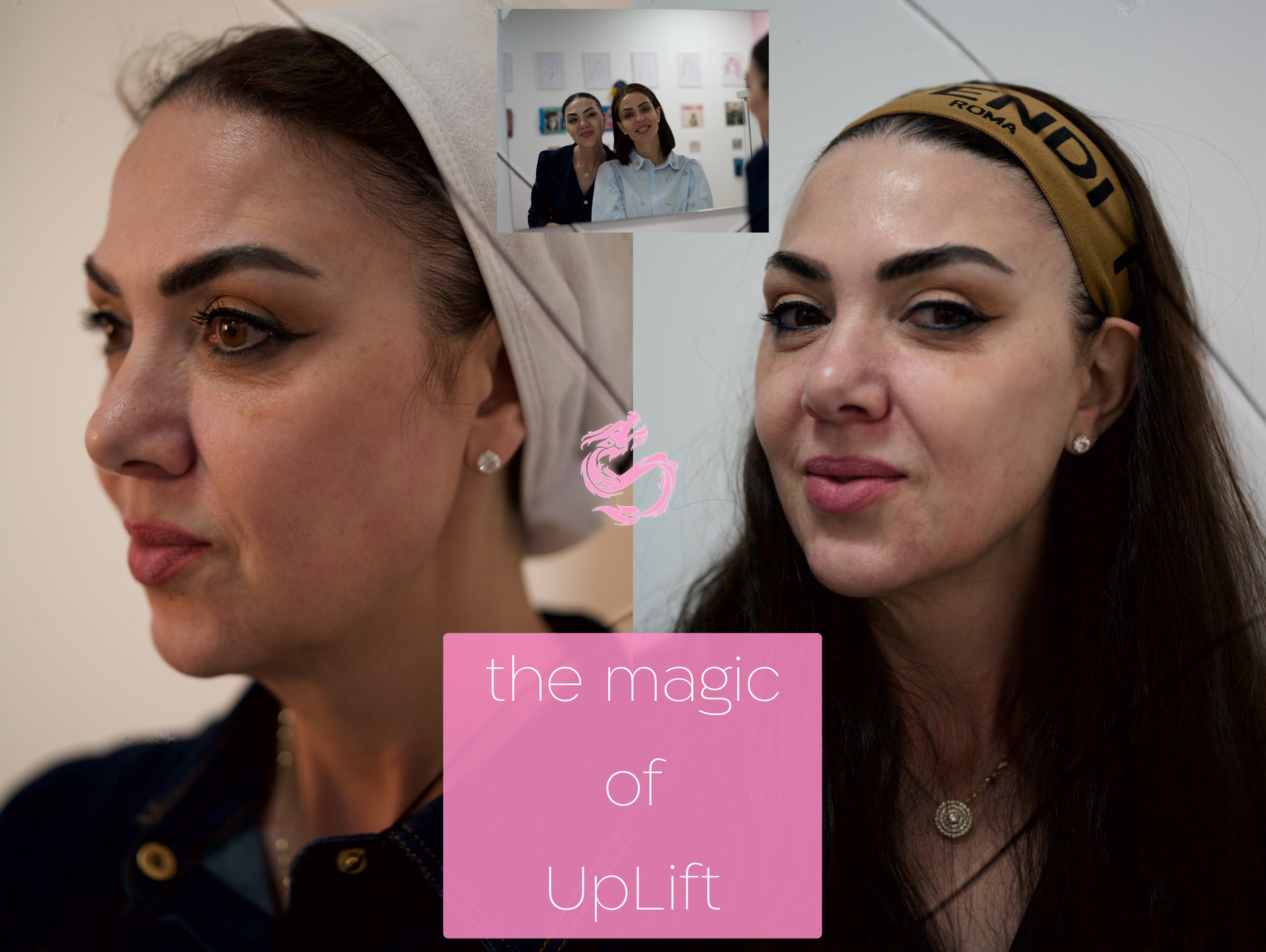 UpLift - מתיחת פנים בלייזר שמבטלת צורך בניתוח 3 מתיחת פנים ב 21 דקות