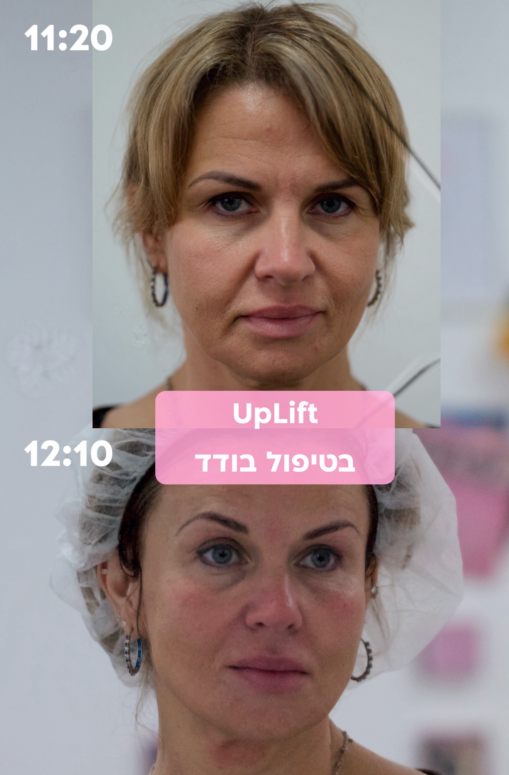 ‎⁨מתיחת פנים נרקיסיה⁩