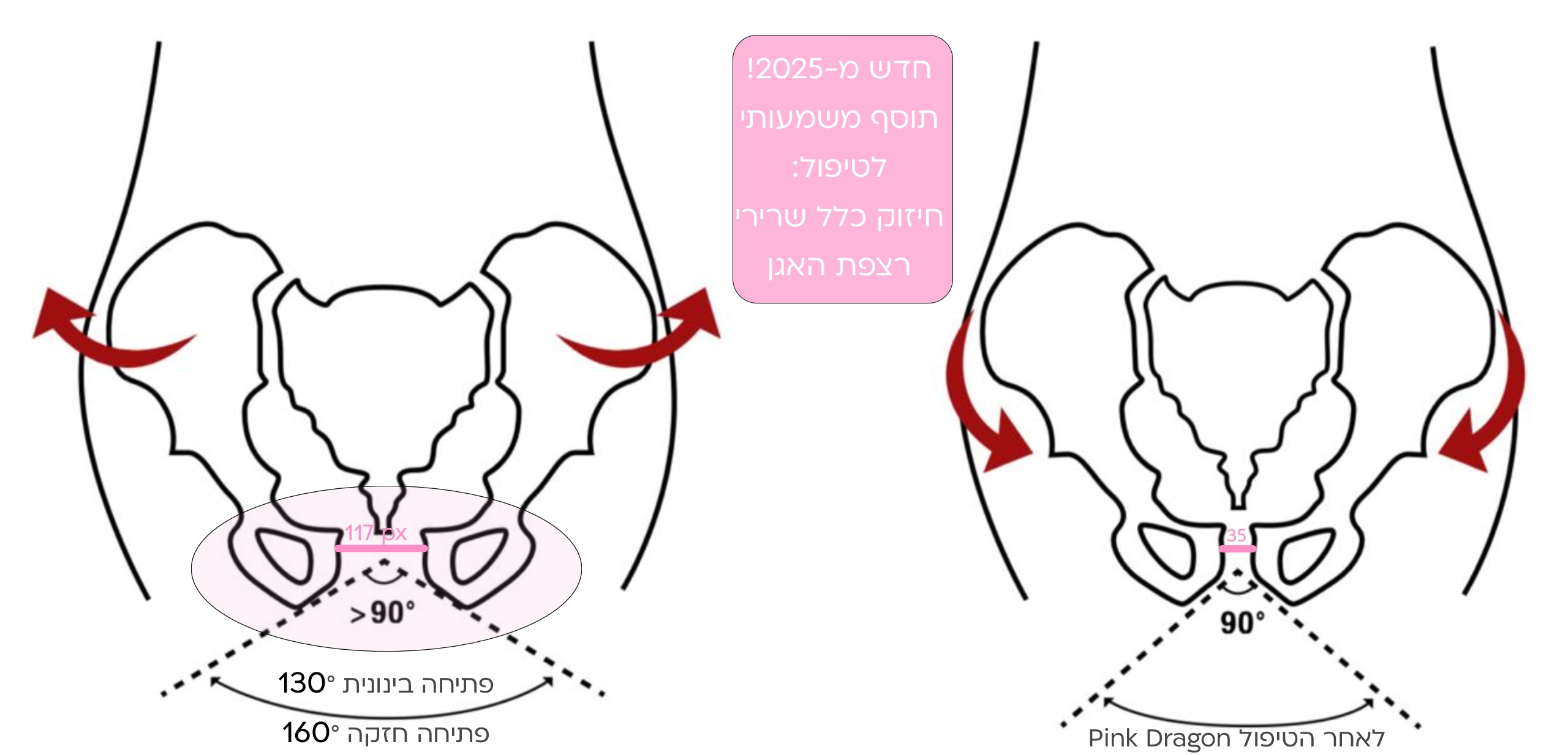 דליפת שתן | טיפול בלייזר שפותר בעיה 8 טיפול בדליפת שתן במרפאת נרקיסיה