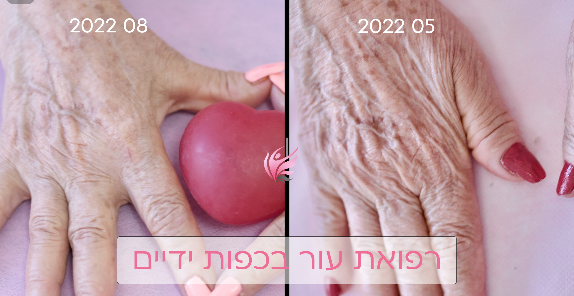 הצערת מראה כפות הידיים בלייזר 3 העלמת קמטים בידיים