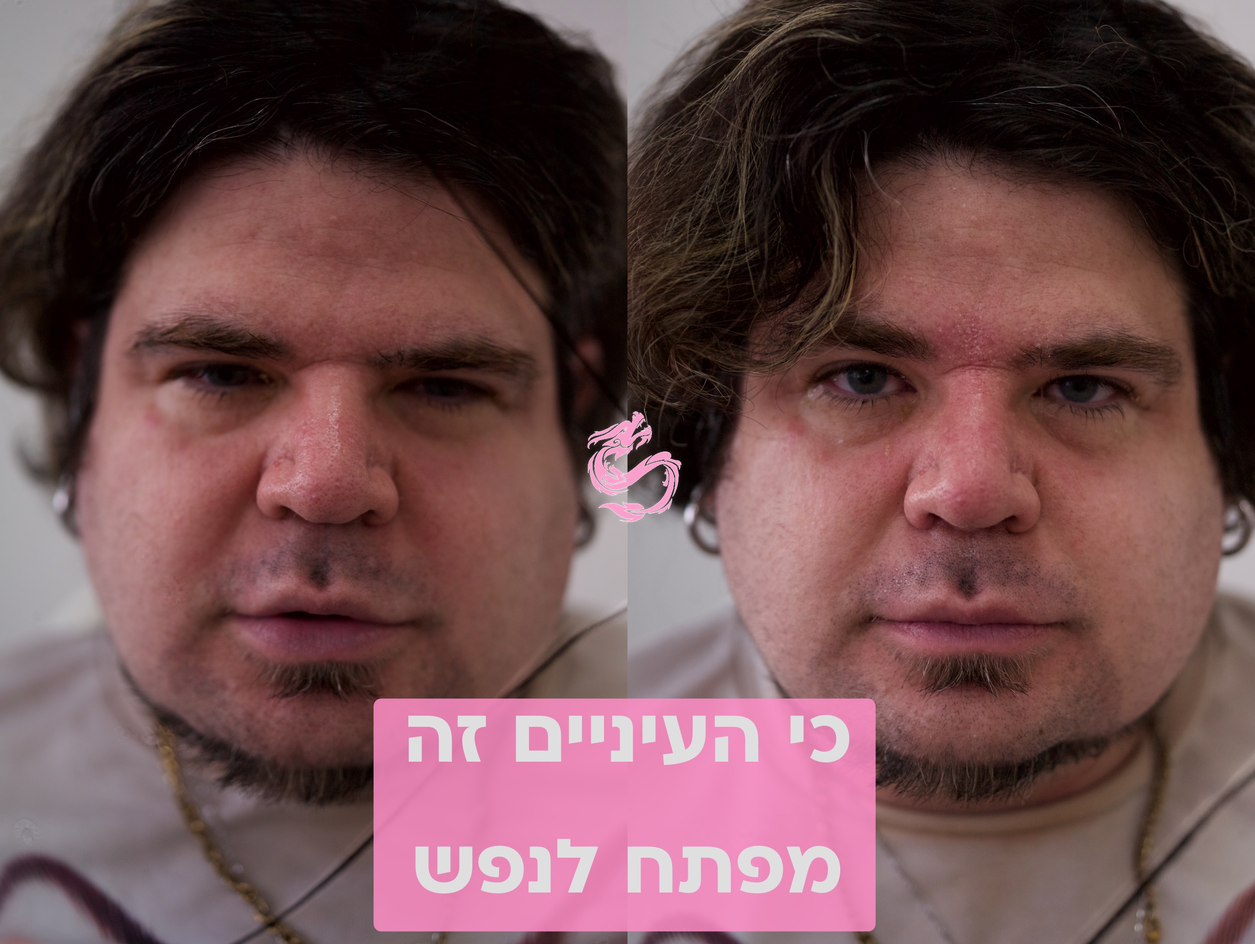 פתיחת עיניים עם לייזר בנרקיסיה