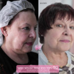 5D treatment 2023 before after