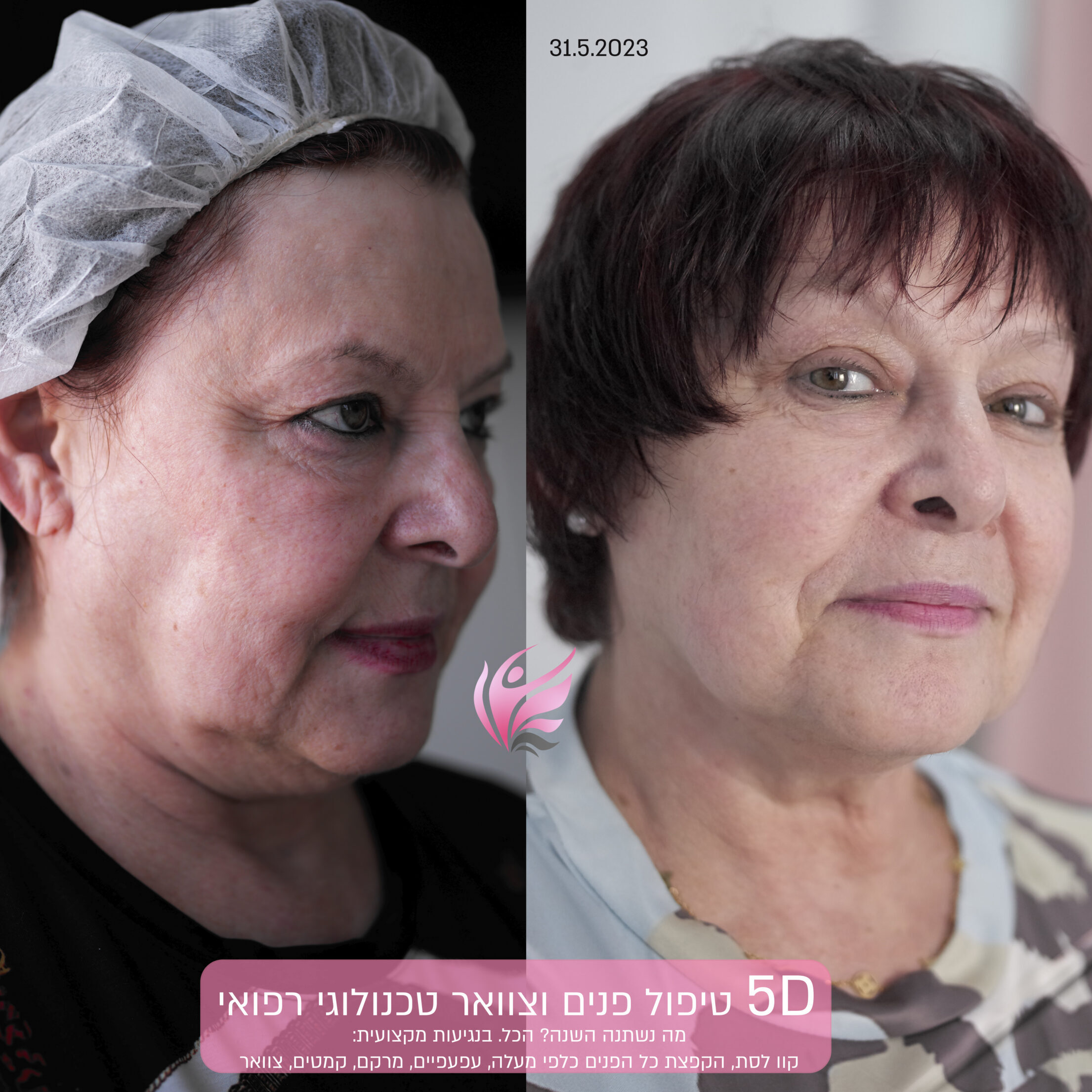 5D treatment 2023 before after