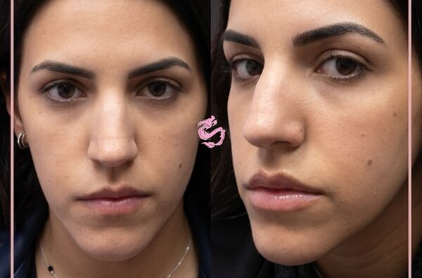 ™Лазерное увеличение губ - Fotona SmoothLips 1 לאחר הגדלת שפתיים בלייזר