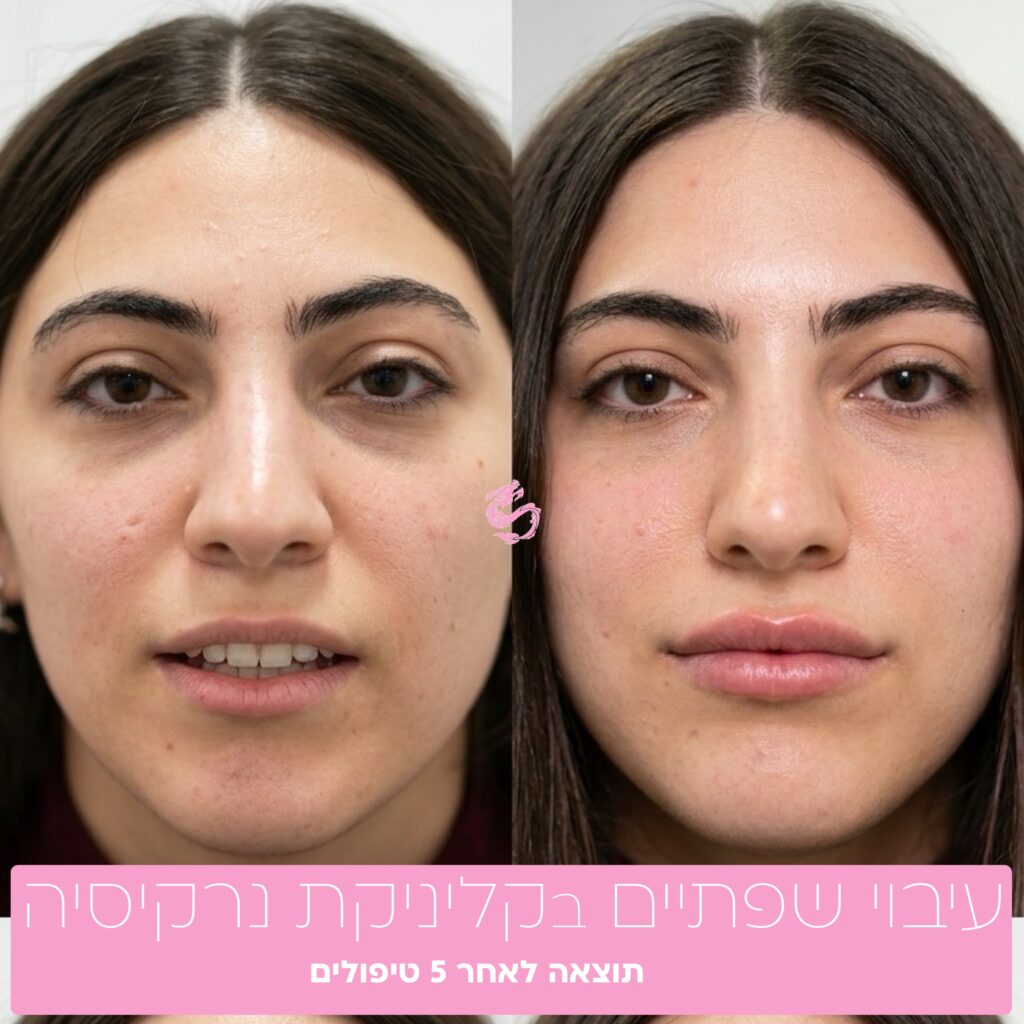 לאחר עיבוי שפתיים בלייזר בקליניקת נרקיסיה