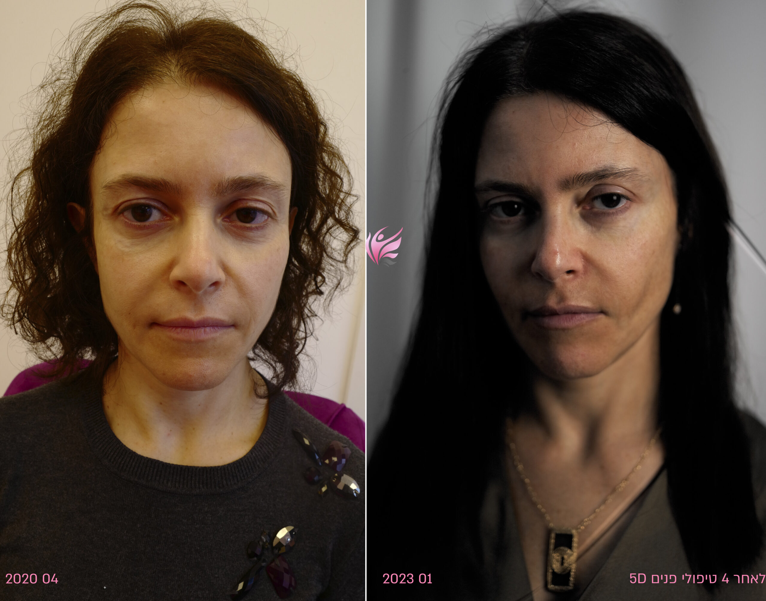 Before and after 5D