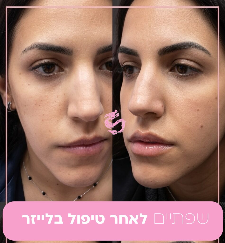 עיבוי שפתיים בלייזר נרקיסיה