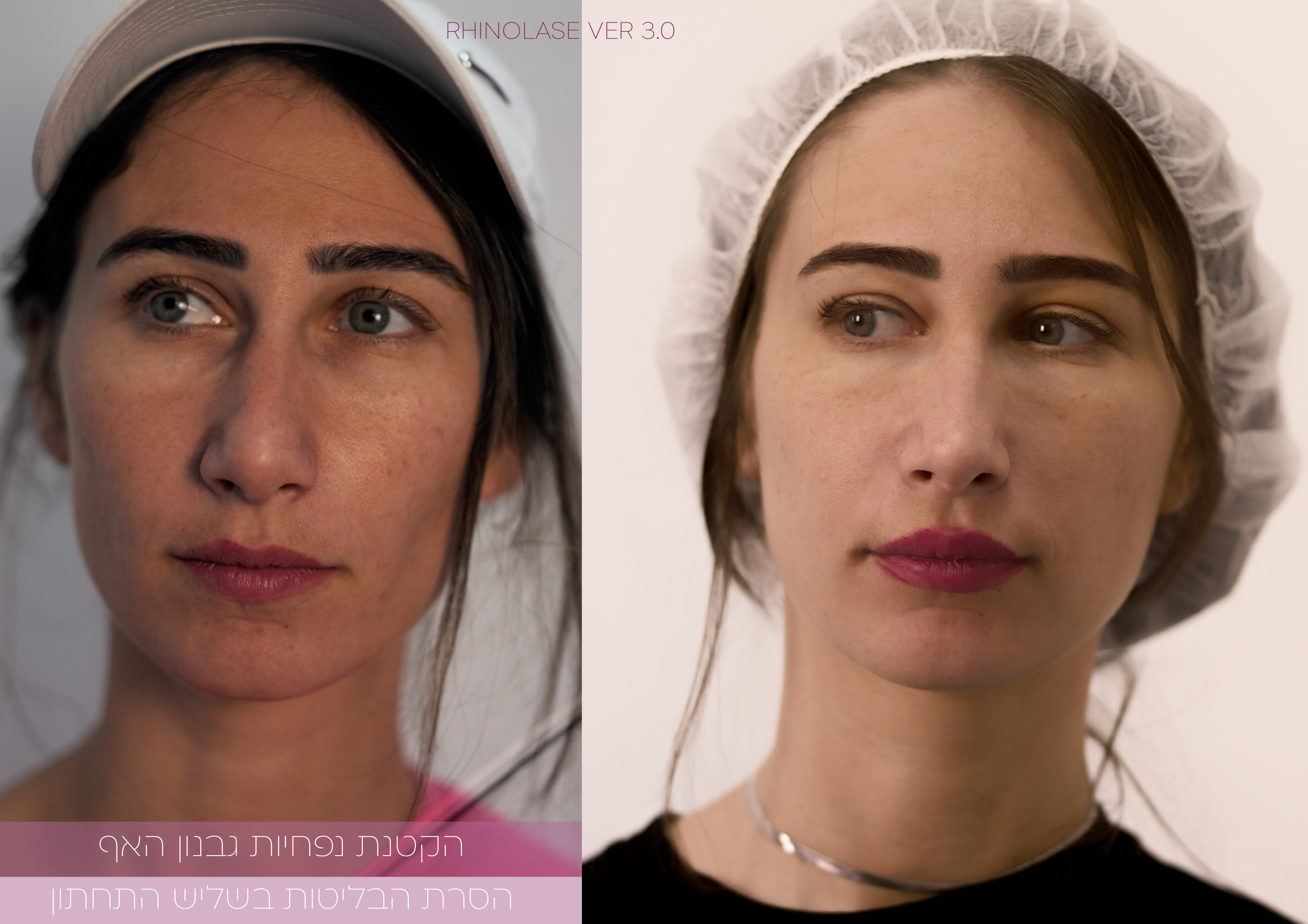 RhinoLase ver 3.0 by Narcissia Aesthetics