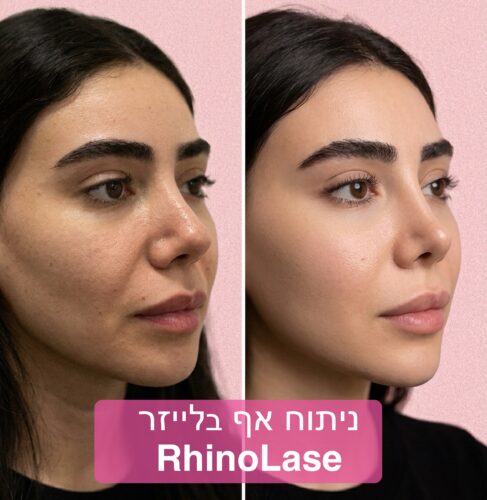 פיסול אף בלייזר
