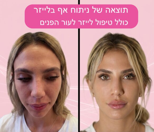 ניתוח/פיסול אף בלייזר 2 IMG 0286
