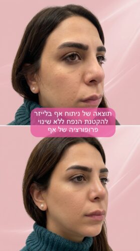نحت الأنف الدائم بدون جراحة | تصغير الأنف | ليزر بدون تقطيع | RhinoLase 13 IMG 0291