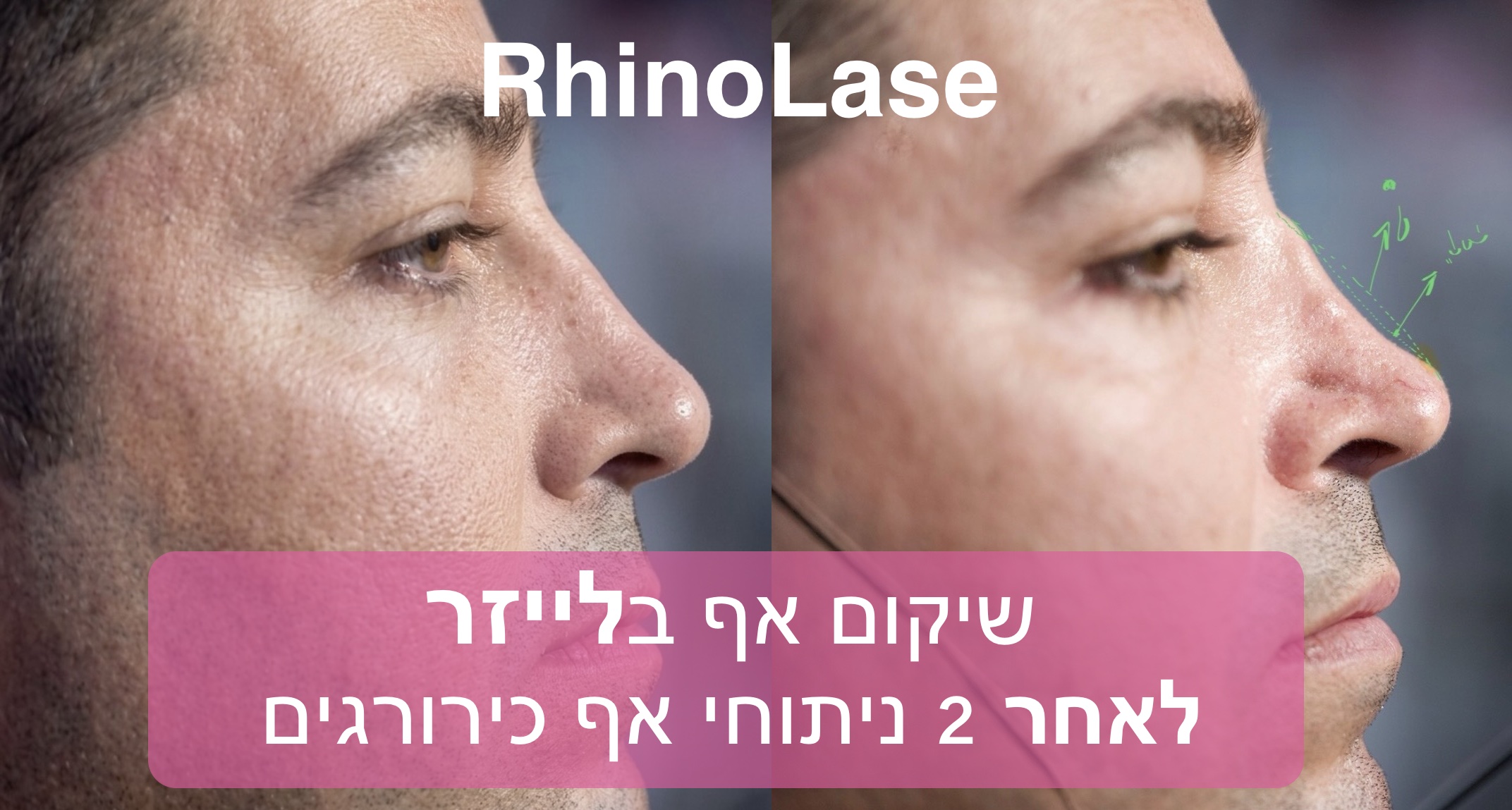 نحت الأنف الدائم بدون جراحة | تصغير الأنف | ليزر بدون تقطيع | RhinoLase 14 IMG 0330