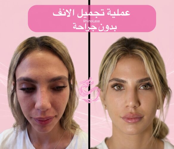 نحت الأنف الدائم بدون جراحة | تصغير الأنف | ليزر بدون تقطيع | RhinoLase 2 RhinoLase