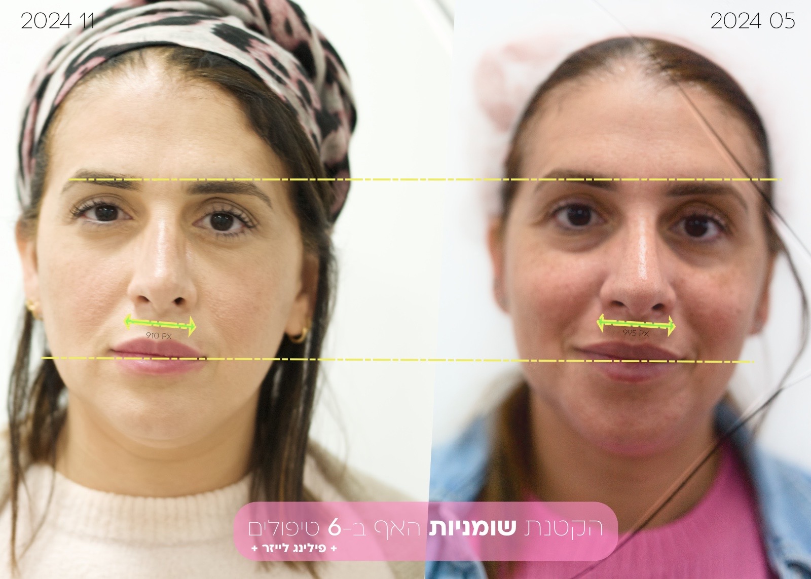 نحت الأنف الدائم بدون جراحة | تصغير الأنف | ليزر بدون تقطيع | RhinoLase 12 Nose volume removal in Narcissia with laser