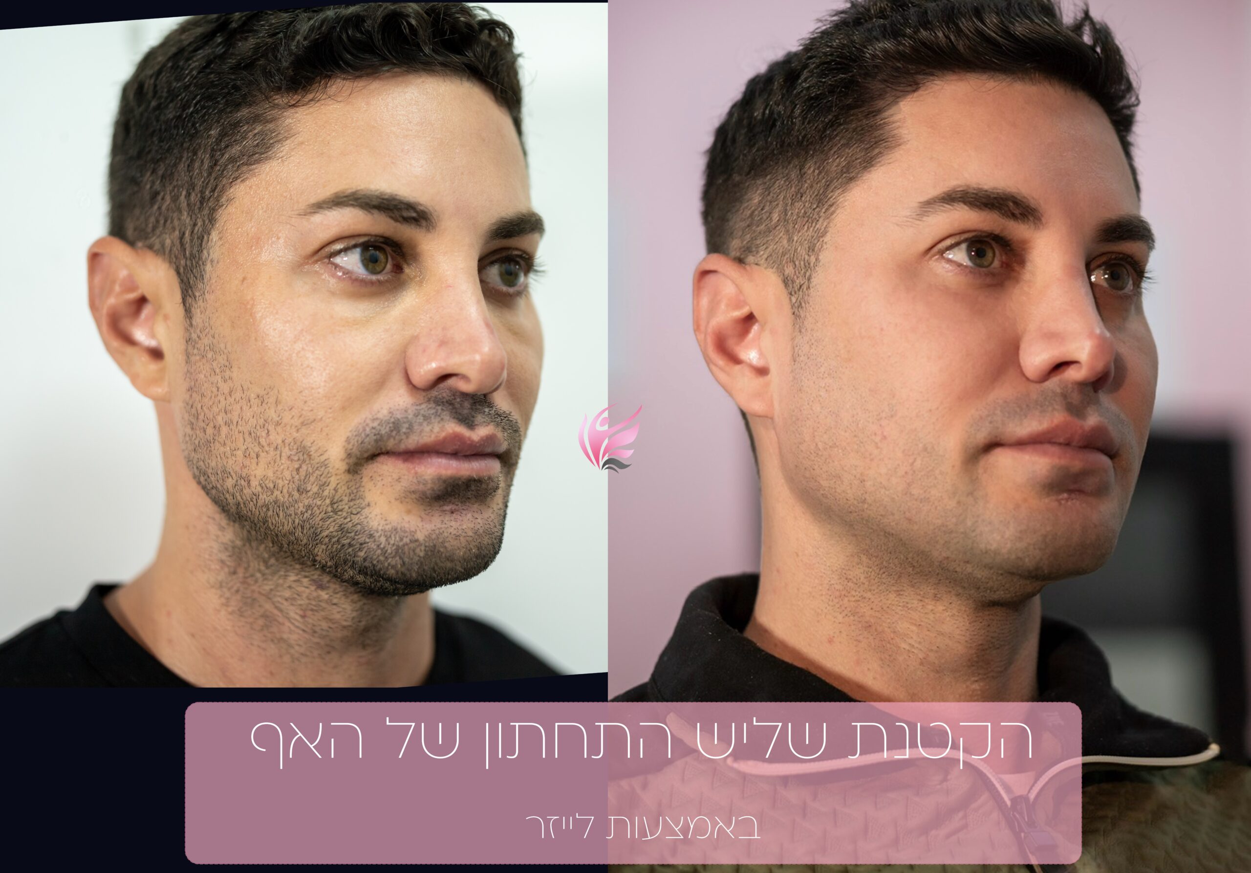 ניתוח/פיסול אף בלייזר 10 הקטנת שליש התחתון של האף
