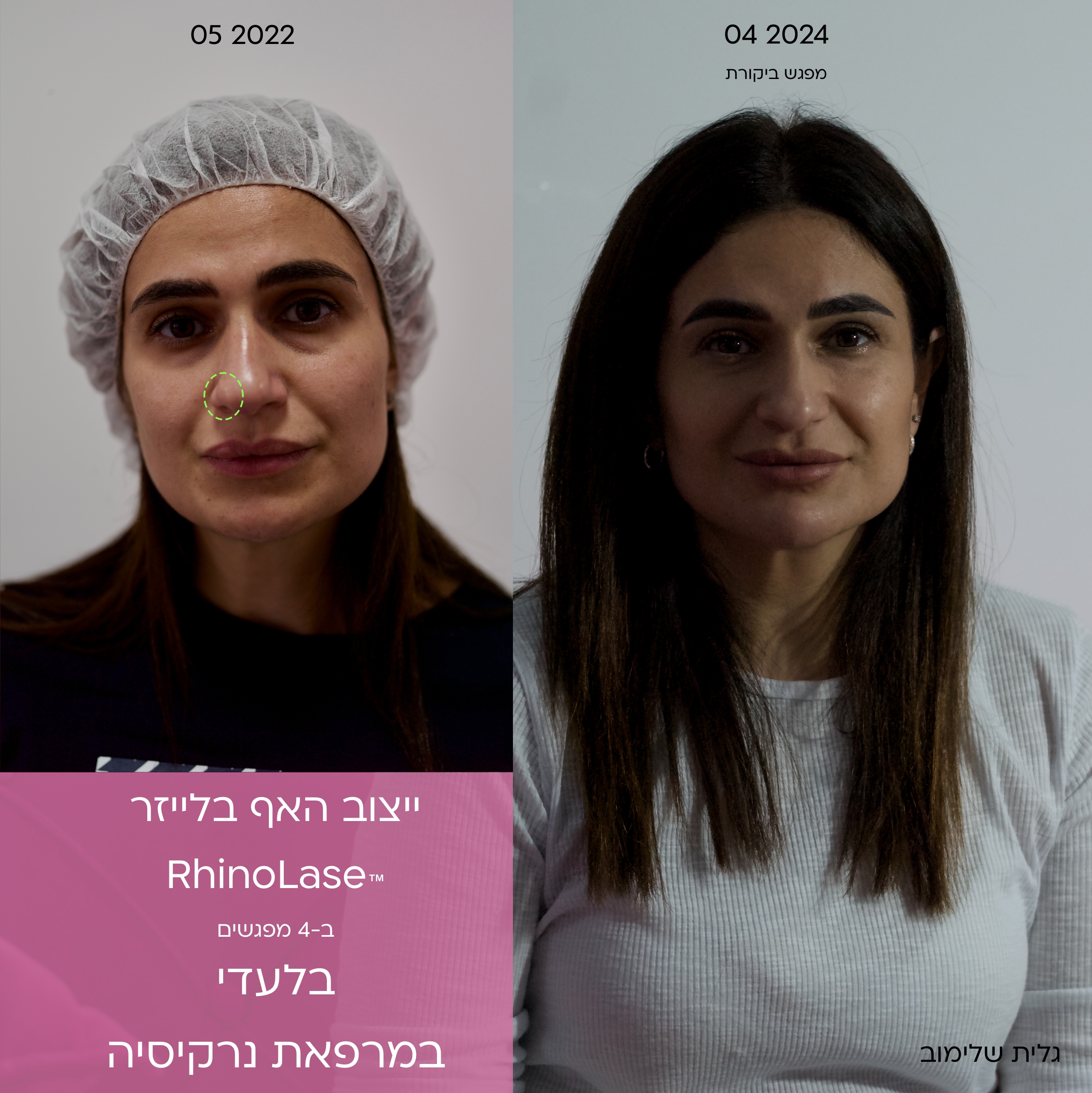 Лазерная ринопластика для красоты и здоровья носа 2 Before after nose laser design treatment