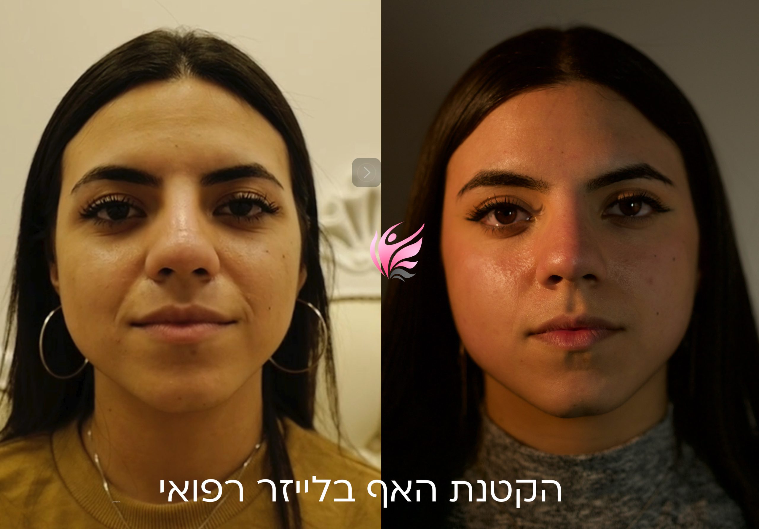 ניתוח/פיסול אף בלייזר 8 RhinoLase