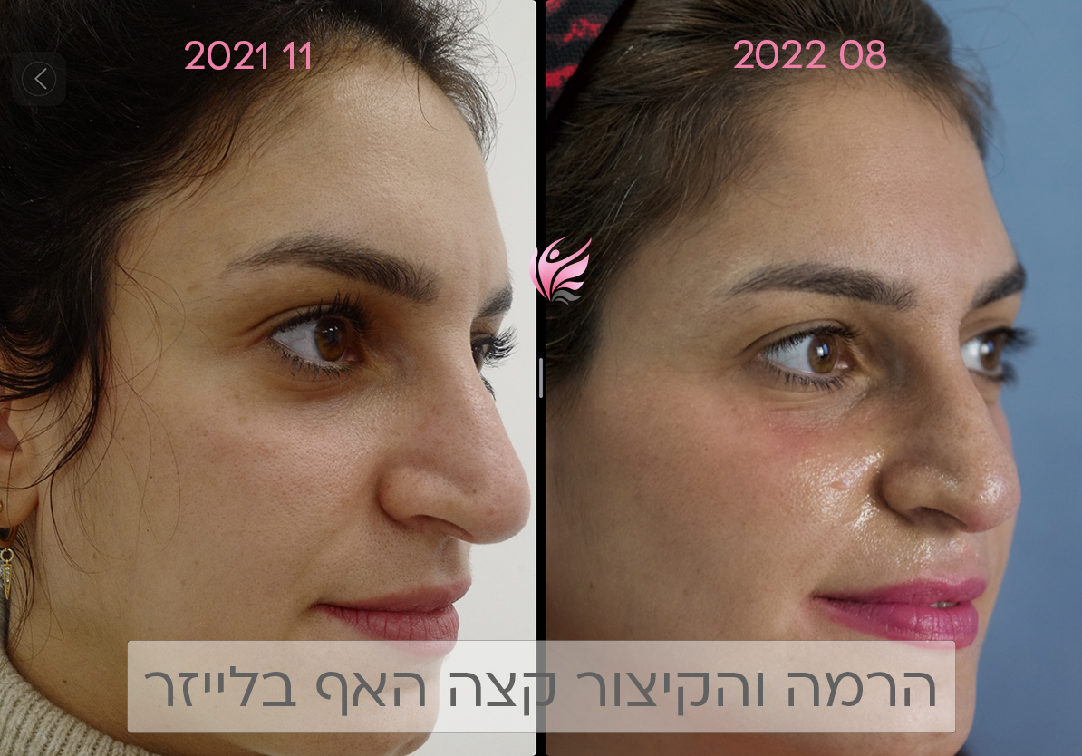 ניתוח/פיסול אף בלייזר 9 Nose Laser Design Narcissia 2022