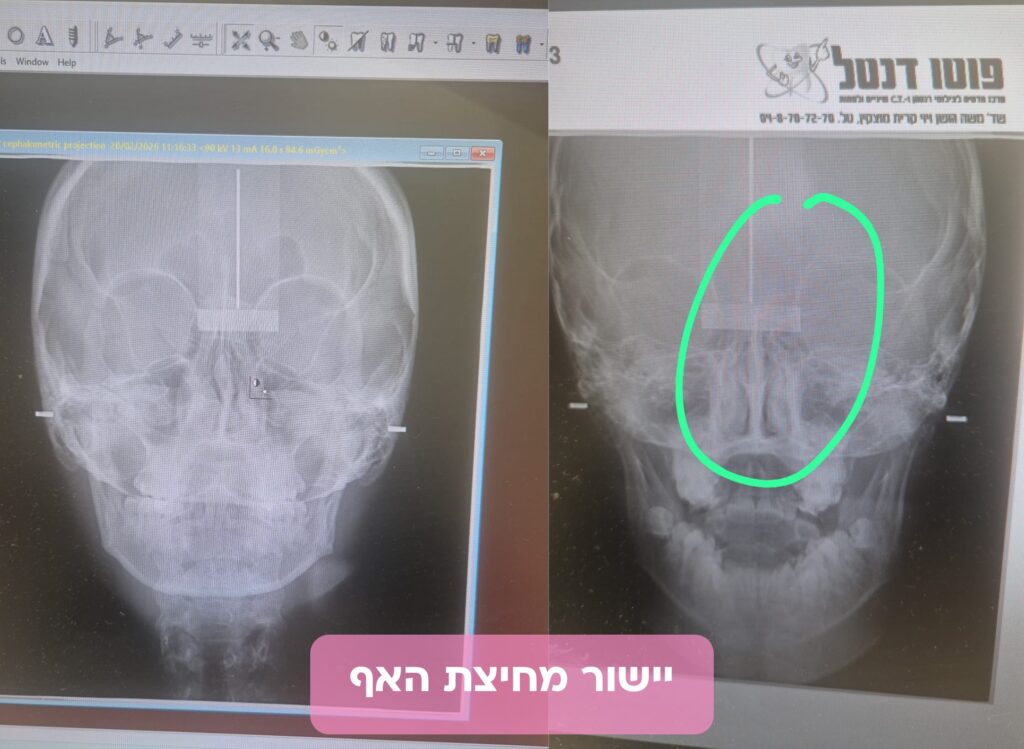 יישור מחיצת האף עם לייזר וחובת ניתוח כירורגי 4 יישור מחיצת האף