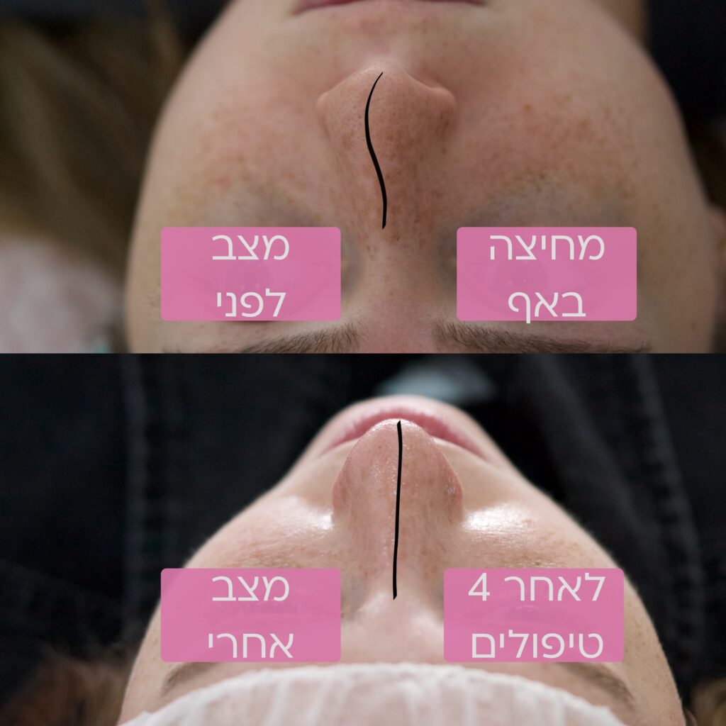 יישור מחיצת האף עם לייזר וחובת ניתוח כירורגי 3 יישור מחיצת האף נרקיסיה