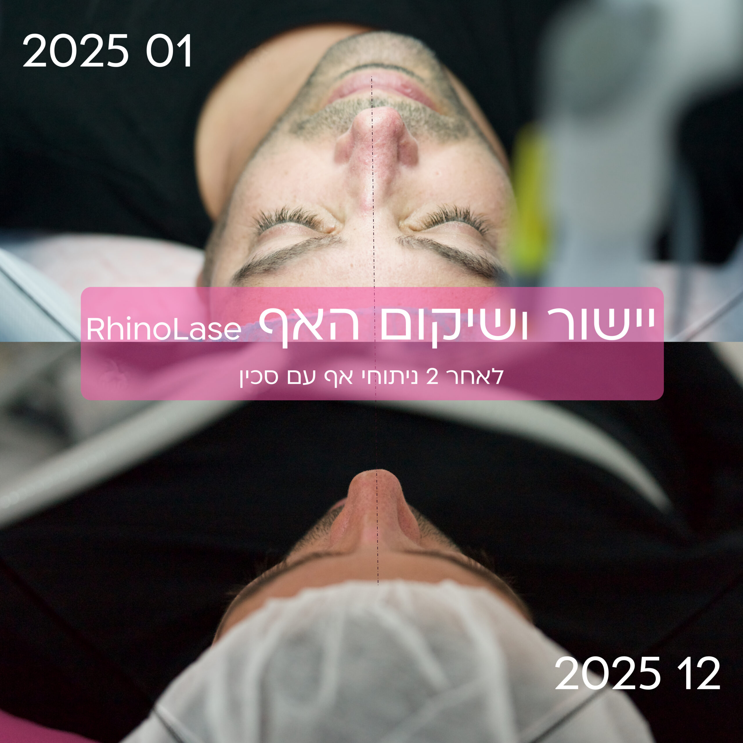 יישור מחיצת האף עם לייזר וחובת ניתוח כירורגי 6 RhinoLase before after
