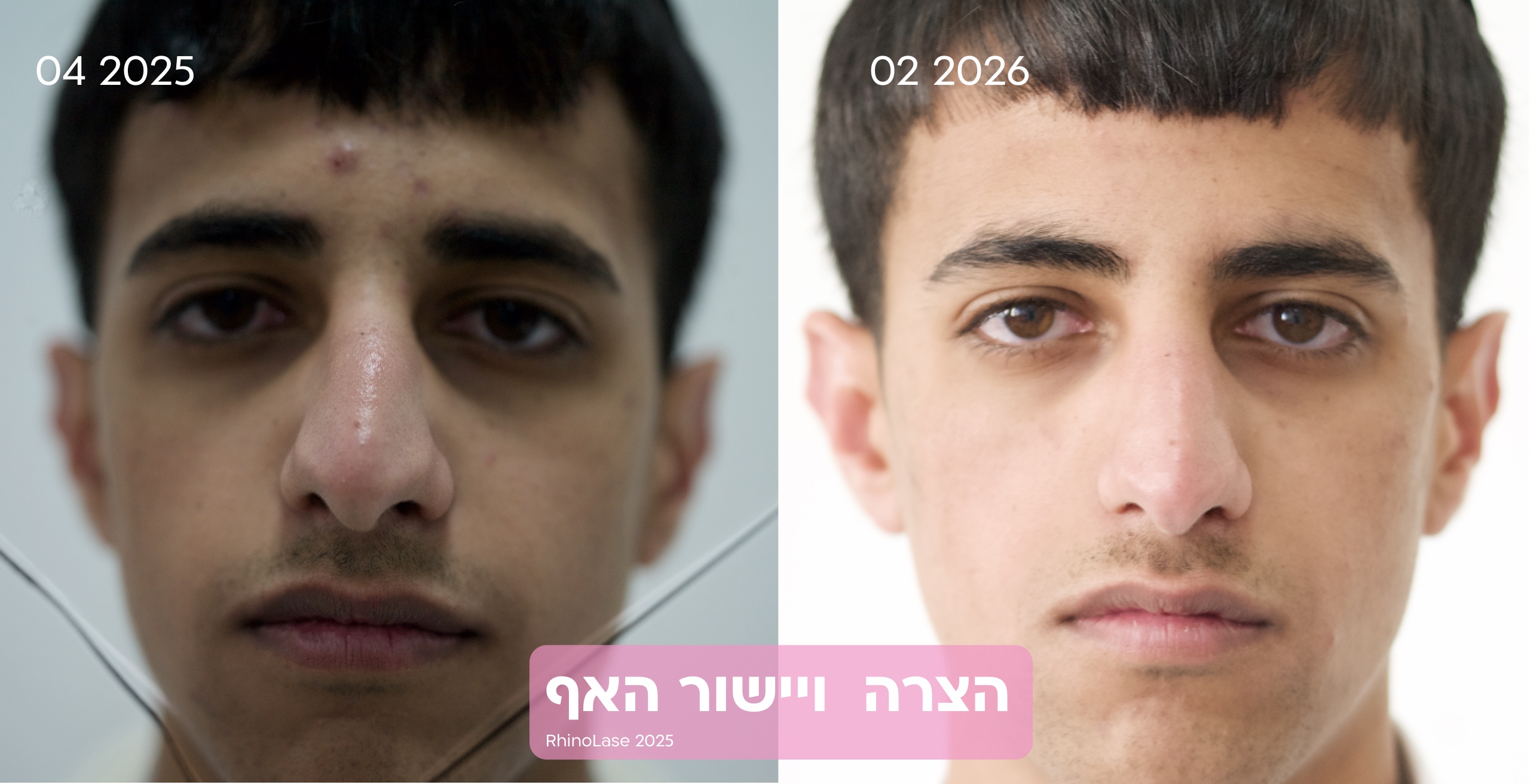ניתוח/פיסול אף בלייזר 12 לפני ואחרי הצרת אף RhinoLase