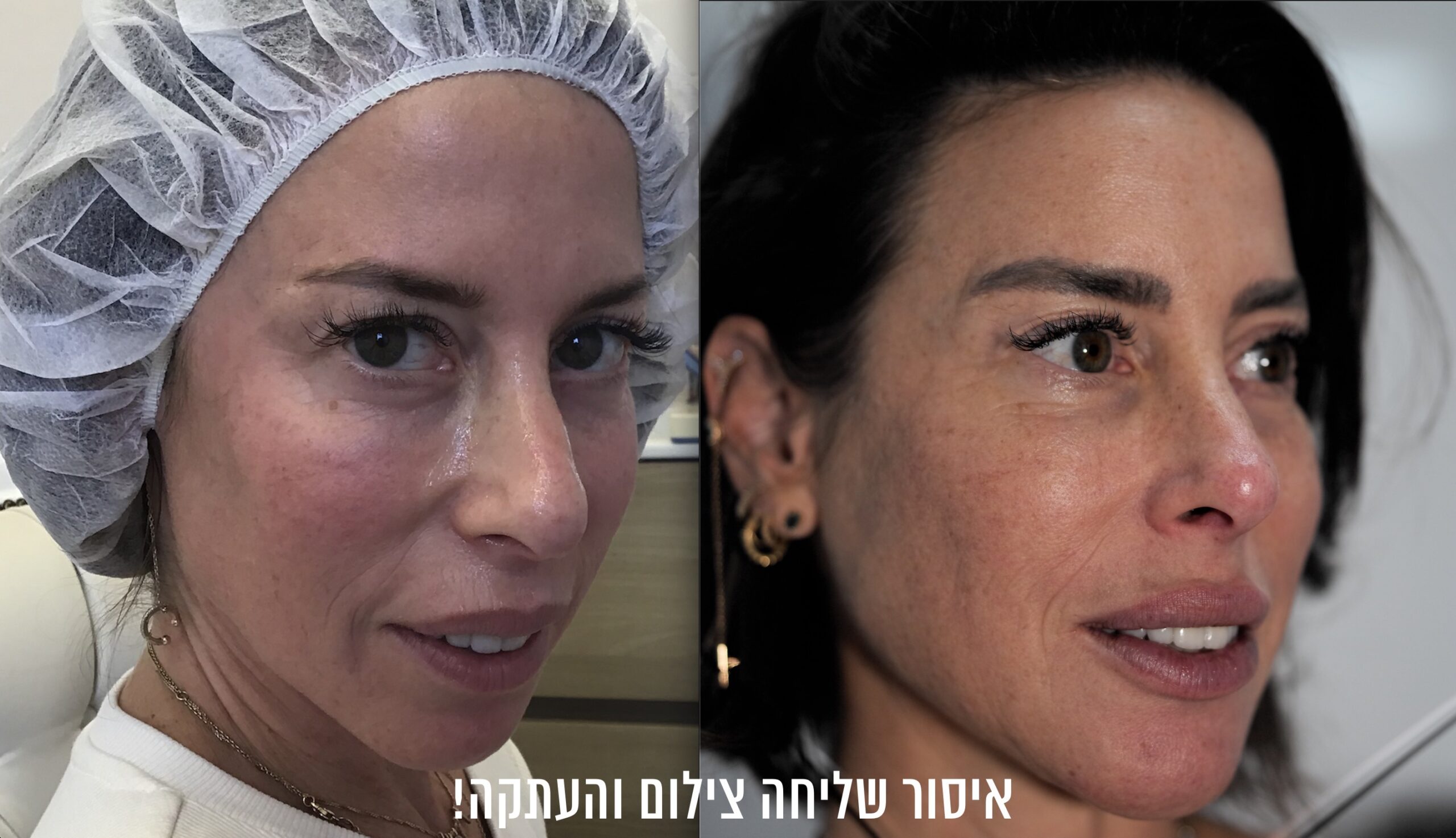 ניתוח/פיסול אף בלייזר 6 עידון האף בלייזר