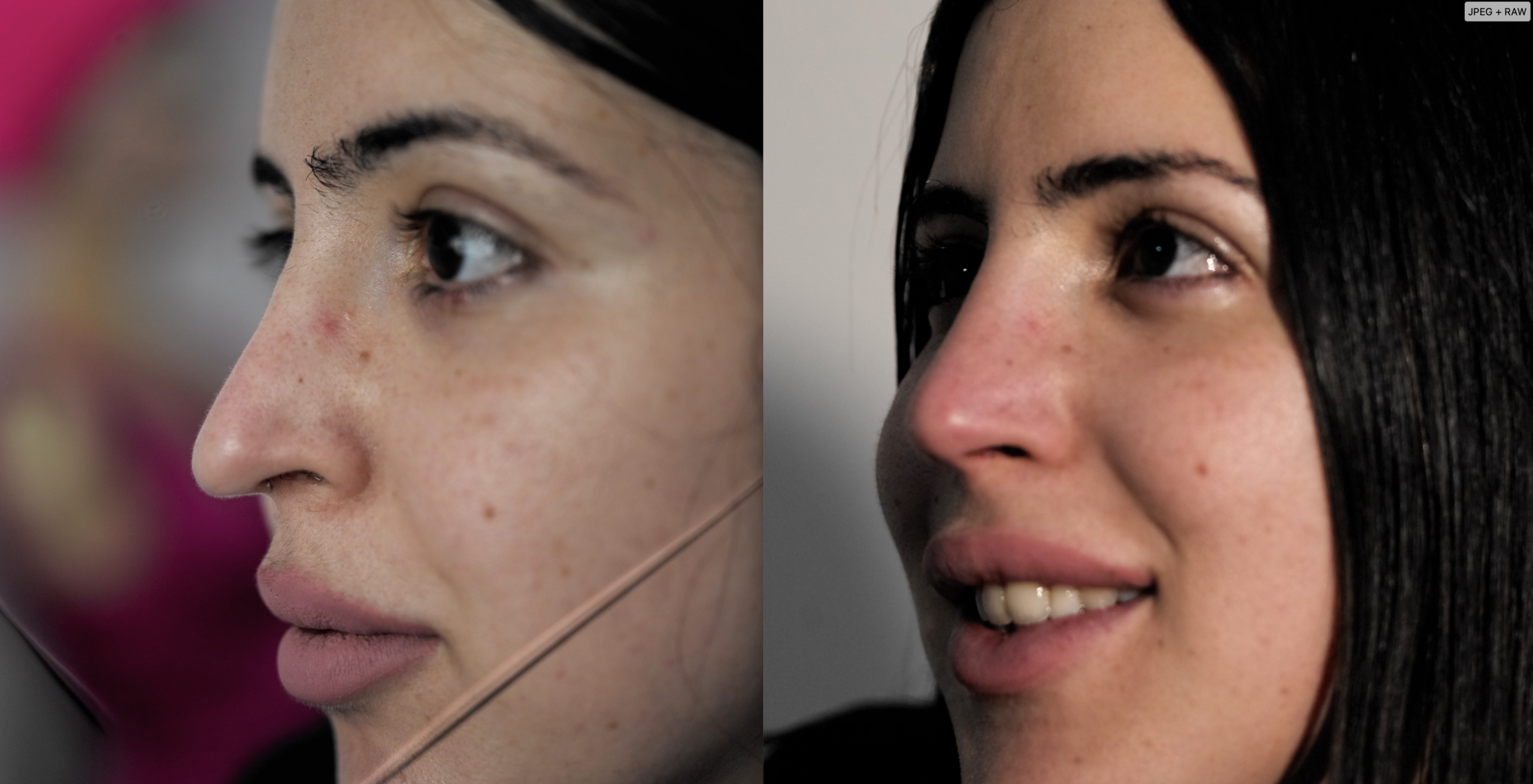 نحت الأنف الدائم بدون جراحة | تصغير الأنف | ليزر بدون تقطيع | RhinoLase 8 הקטנת אורך האף