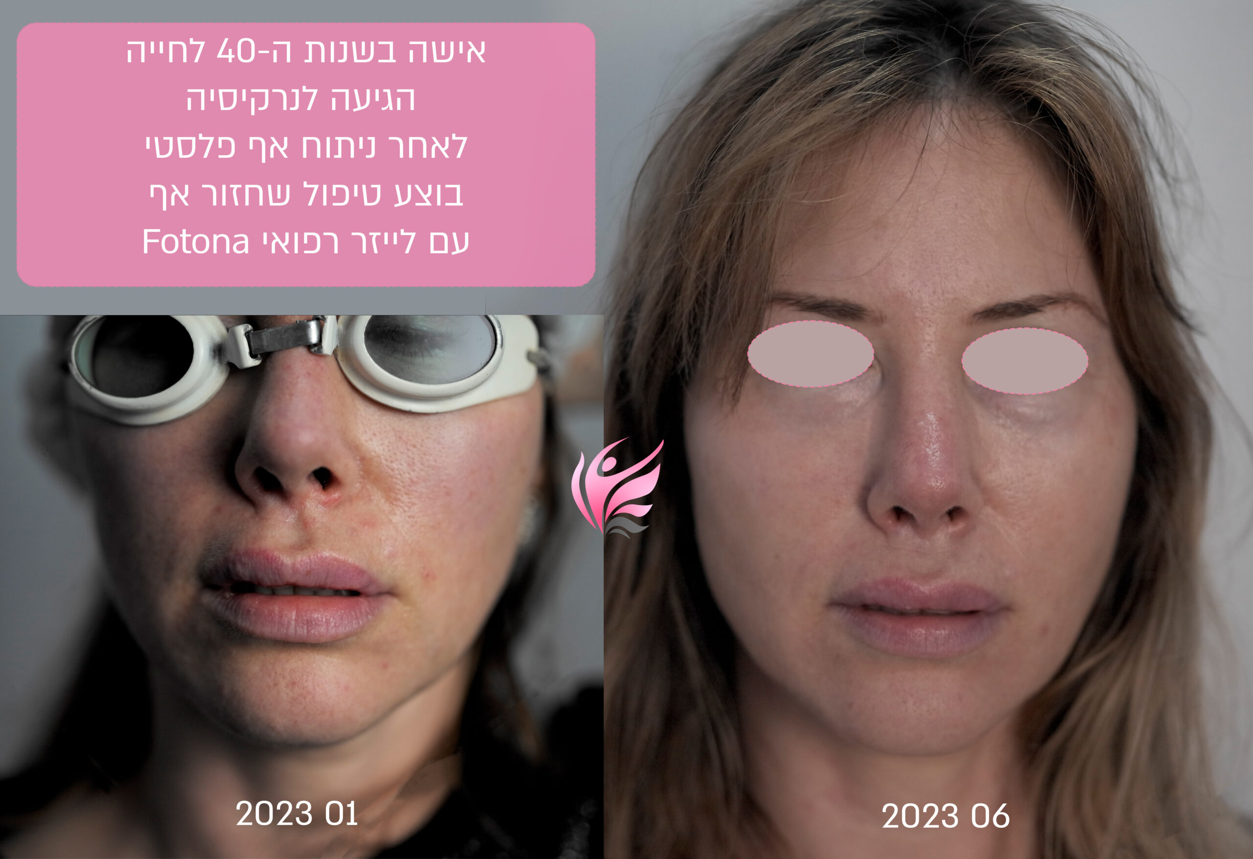 טיפול באף באמצעות לייזר רפואי בנרקיסיה