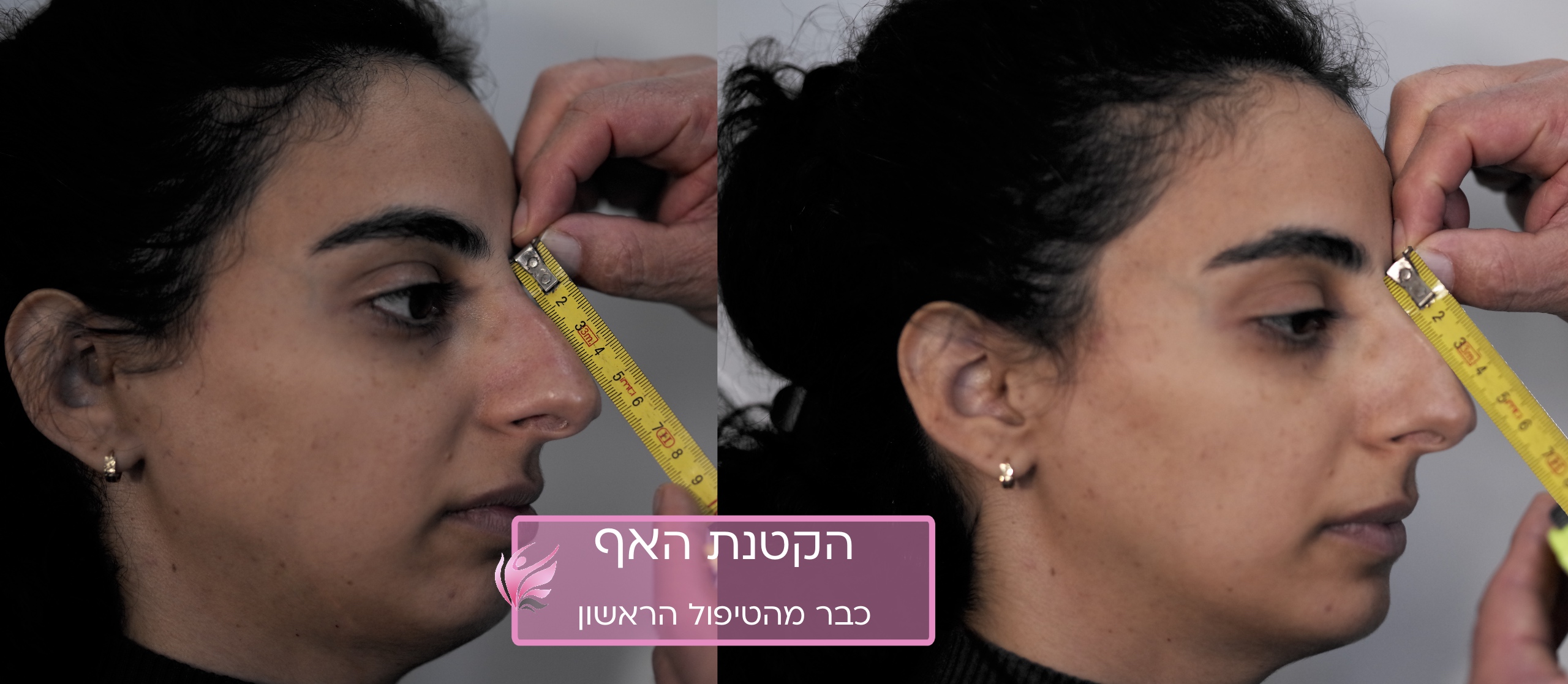 Лазерная ринопластика для красоты и здоровья носа 1 Before and after the first RhinoLase ver. 3.0 treatment