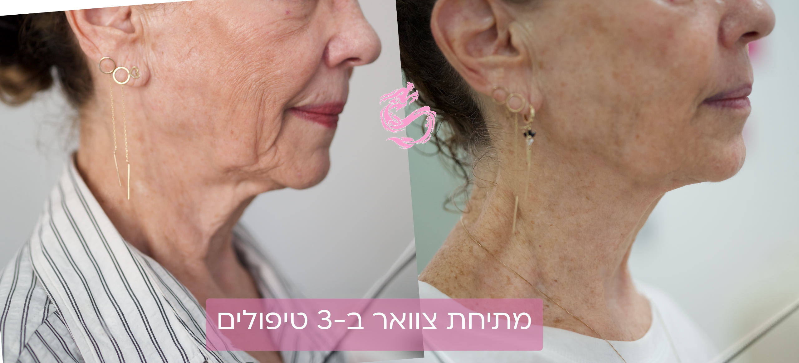 מתיחת צוואר בלייזר נרקיסיה