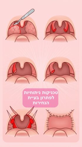 טיפול נחירות שפותר בעיה | ע״י אף אוזן וגרון | בלייזר רפואי 3 שיטות ניתוח בנחירות