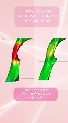 טיפול נחירות שפותר בעיה | ע״י אף אוזן וגרון | בלייזר רפואי 6 IMG 0488