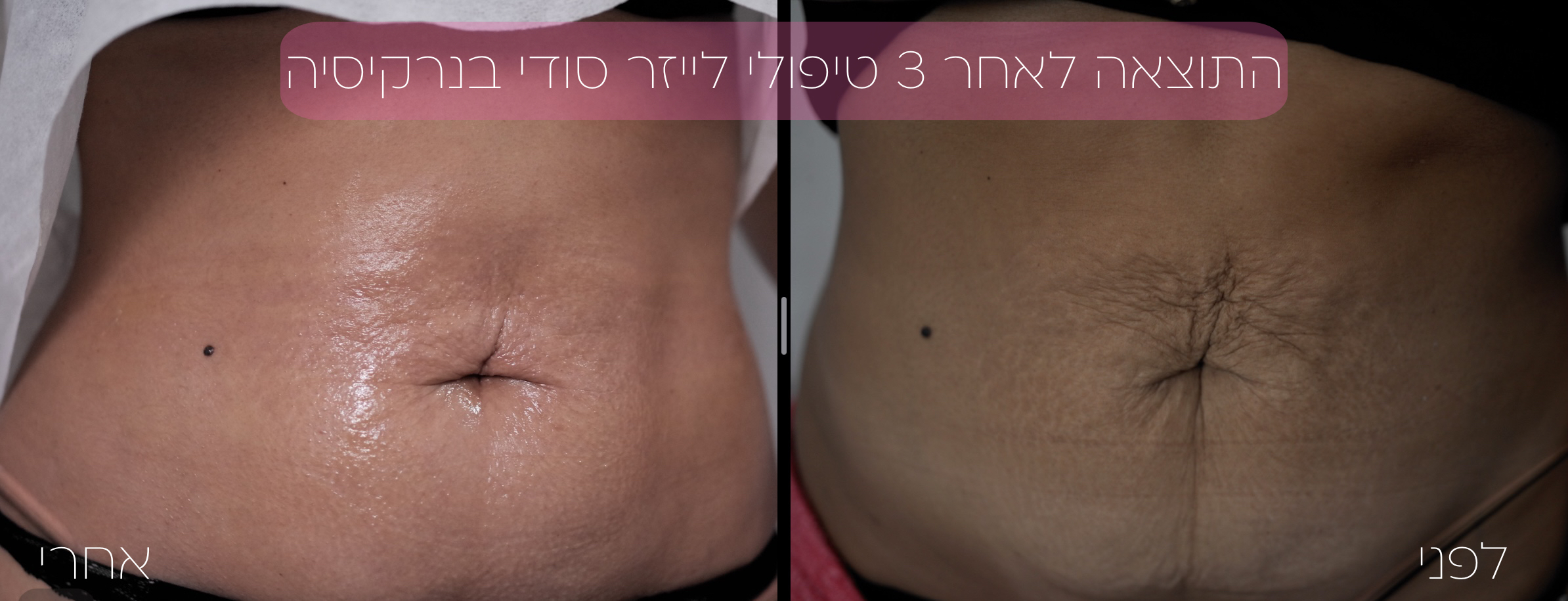 מחוך נצחי בדמות הטיפול להעלמת סימני מתיחה 6 סימני מתיחה