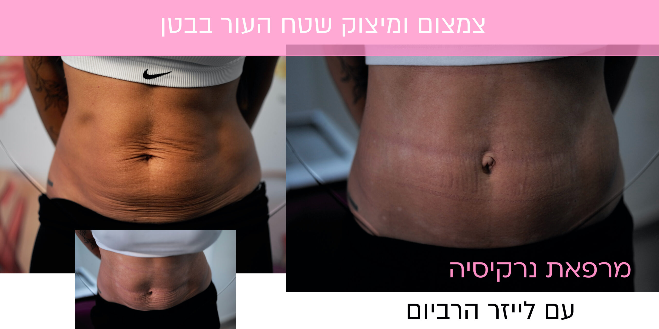 מחוך נצחי בדמות הטיפול להעלמת סימני מתיחה 5 מיצוק עור בבטן scaled