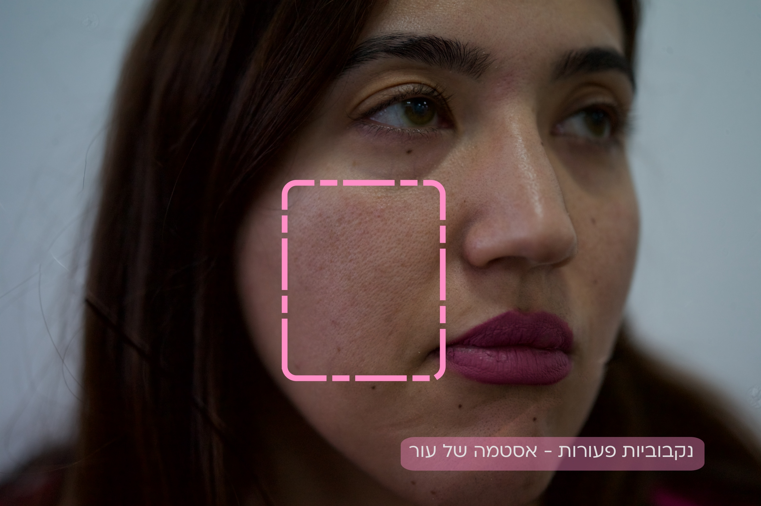 נקבוביות עמוקות | פצעי אקנה | צלקות אקנה | PostAcne | לדוגמאות היכנסו 2 אסטמה של עור הפנים