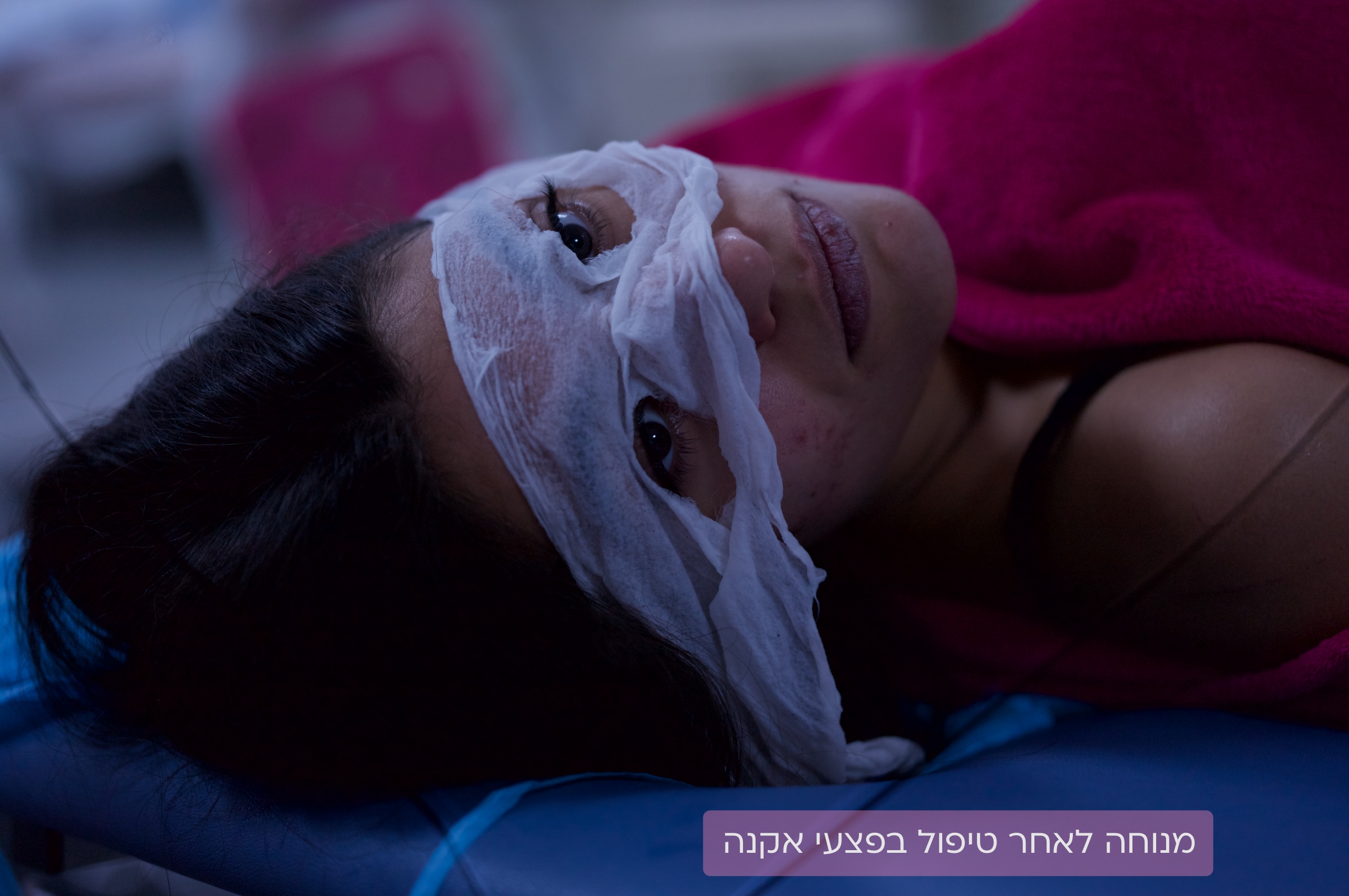 נקבוביות עמוקות | פצעי אקנה | צלקות אקנה | PostAcne | לדוגמאות היכנסו 7 מנוחה לאחר טיפול לייזר בפצעי אקנה