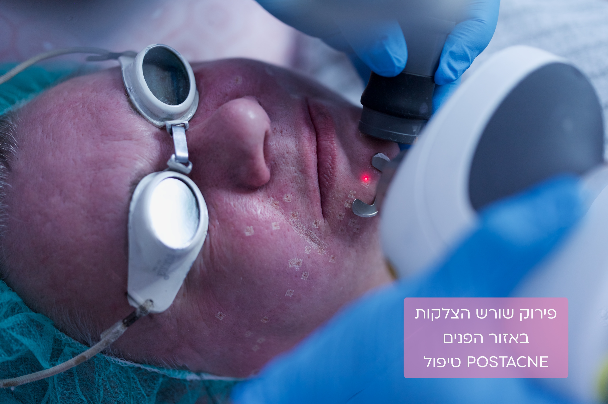 נקבוביות עמוקות | פצעי אקנה | צלקות אקנה | PostAcne | לדוגמאות היכנסו 4 פירוק שורש צלקת באזור הפנים