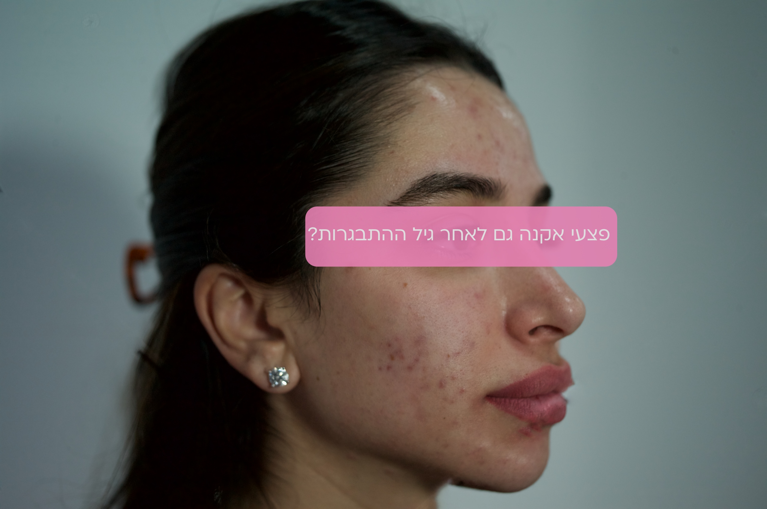 נקבוביות עמוקות | פצעי אקנה | צלקות אקנה | PostAcne | לדוגמאות היכנסו 1 פצעי אקנה