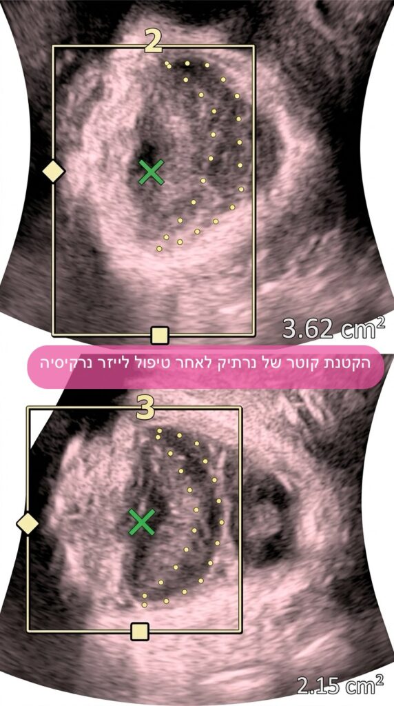 דליפת שתן | טיפול בלייזר שפותר בעיה 2 IMG 0547