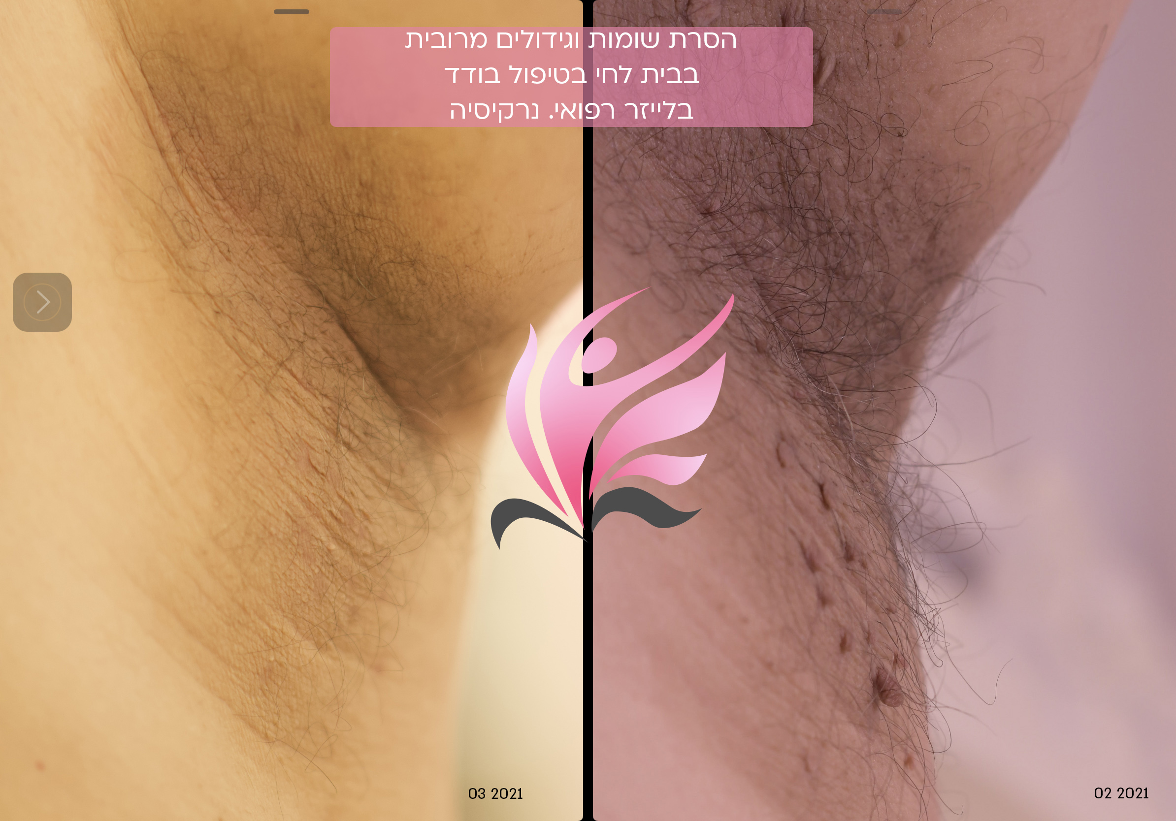 הסרת גידולים בבית לחי