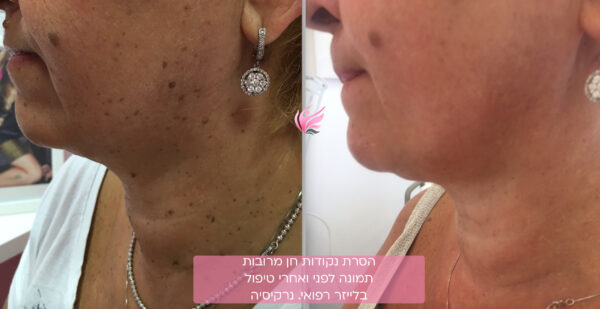 הסרת נקודות חן בפנים וצוואר