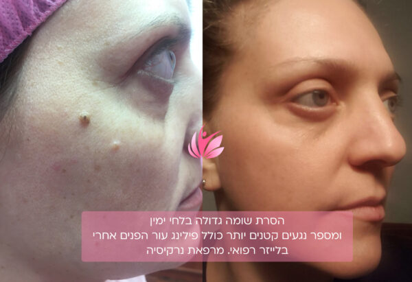 העלמת גידולים