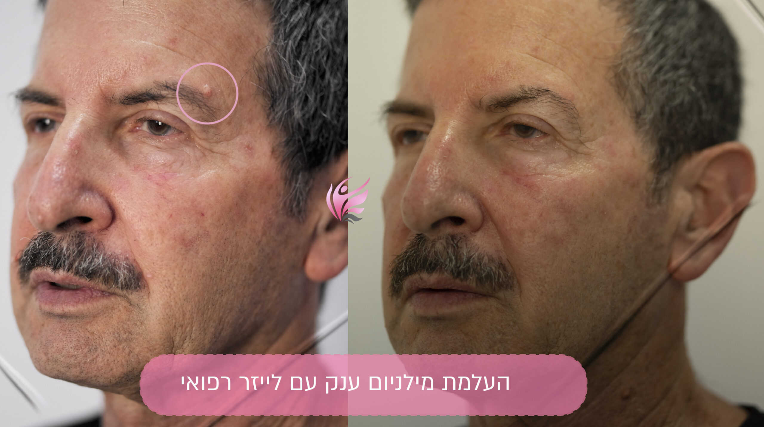 הסרת שומניה ענקית בלייזר