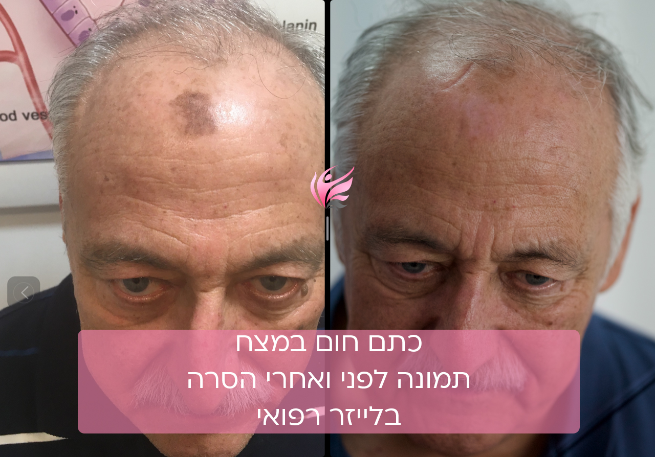 כתם לידה במצח העלמתו
