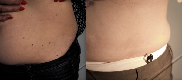 cherry hemangioma removing with Fotona laser in Narcissia Aesthetics