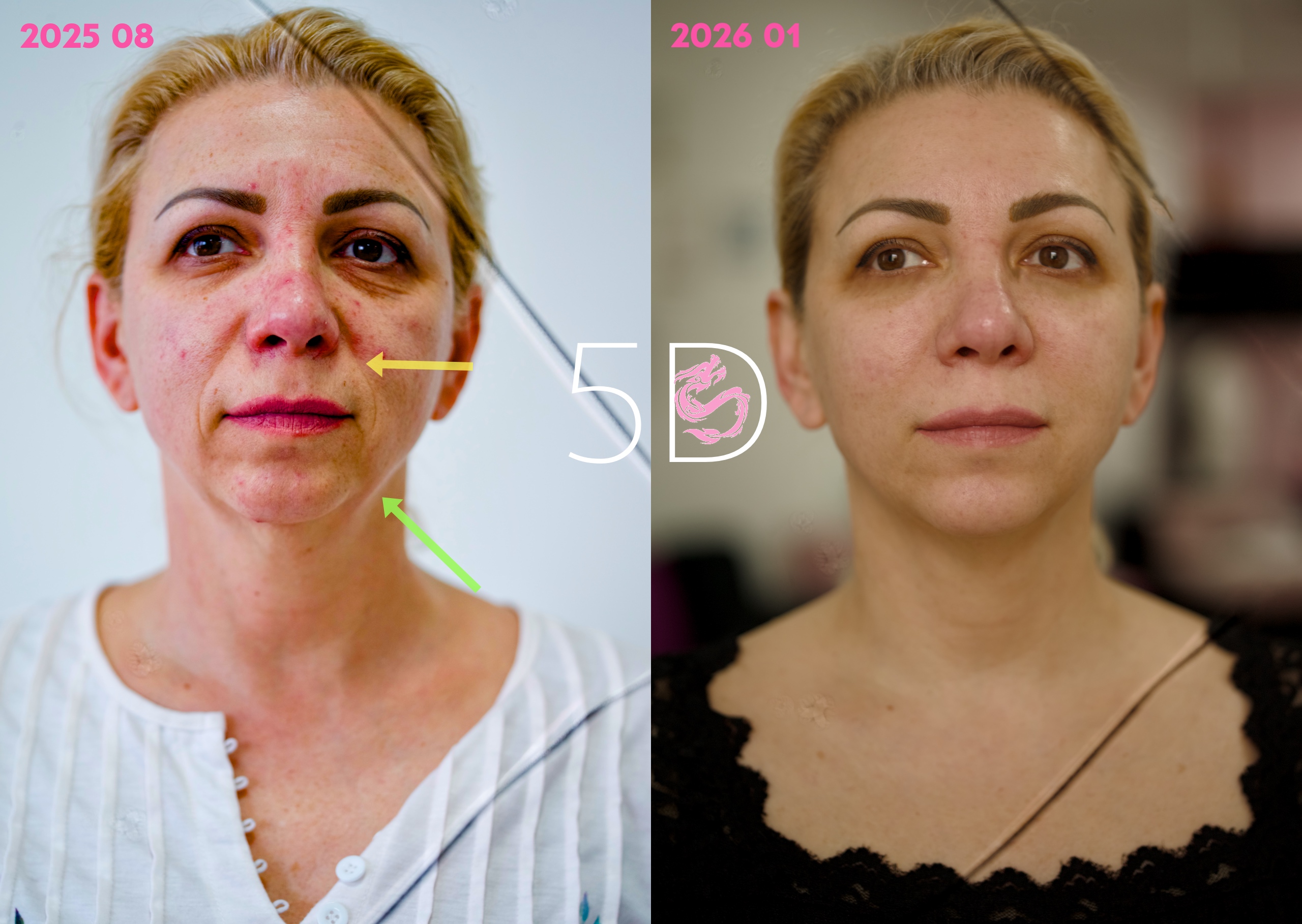 הבהרת כהויות מתחת לעפעף התחתון | טיפול בצבע כחול מתחת לעיניים 3 5D before after 2026